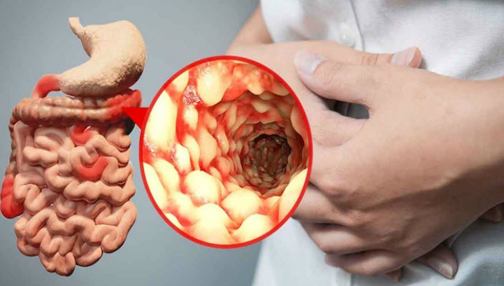 boala crohn artrita mâinilor simptome precoce